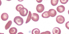 Blood smear illustrating sickle cell anaemia. Source: Scooter Project